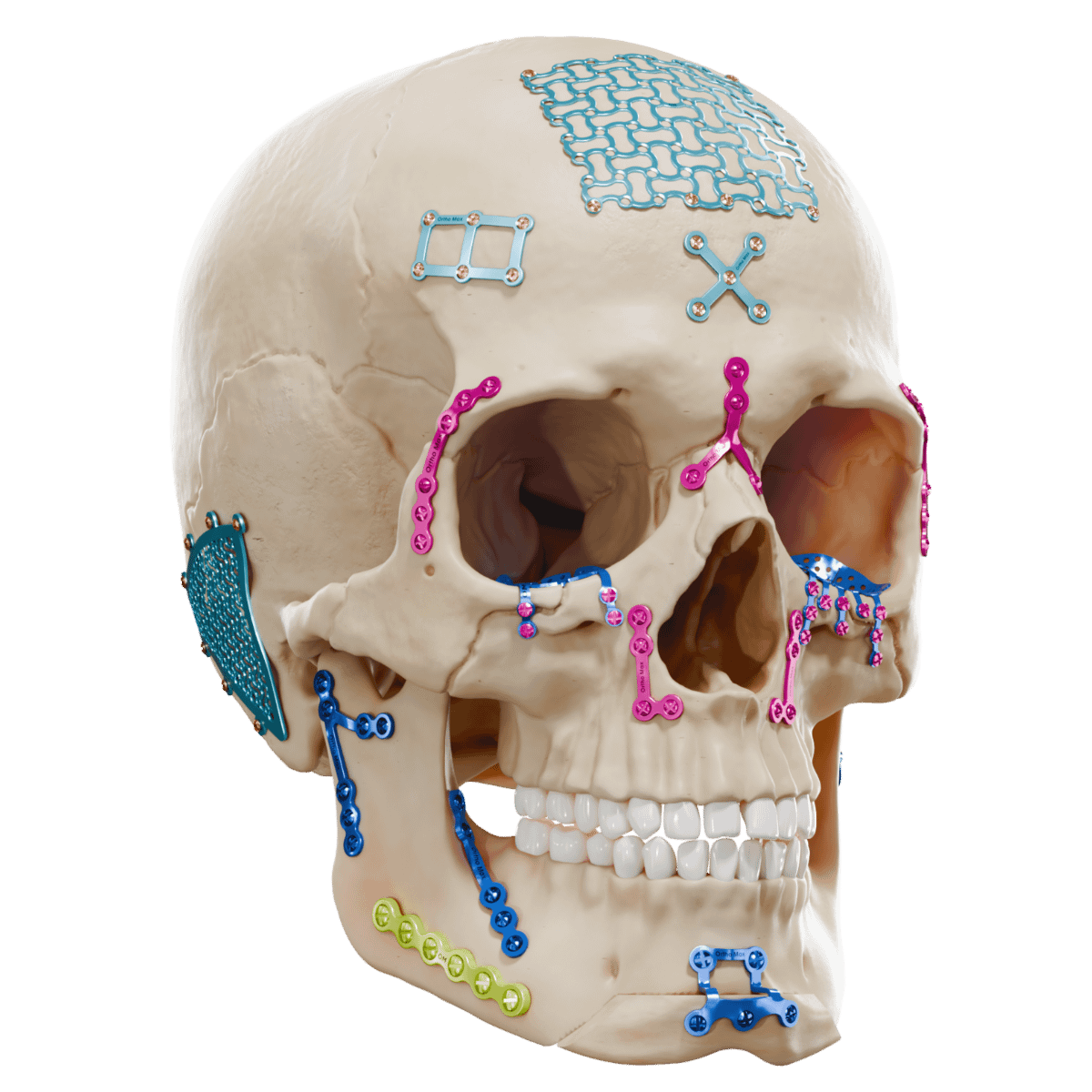 Cranio maxillofacial Right side