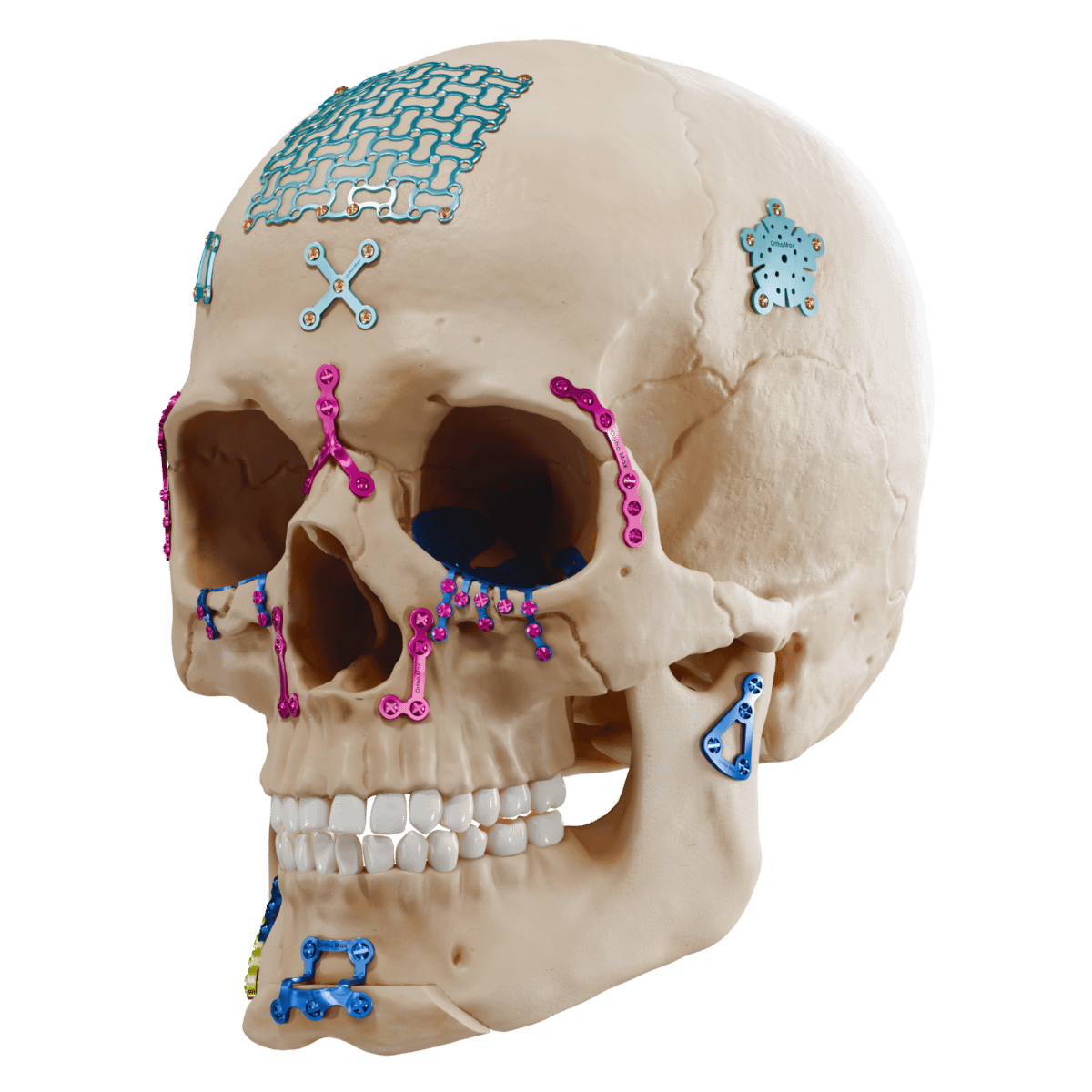 Cranio maxillofacial left side
