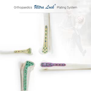 ultra lock plating system by ortho max
