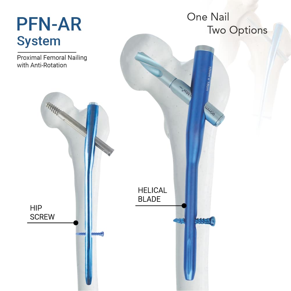 PFN AR femur nail system by orthomax