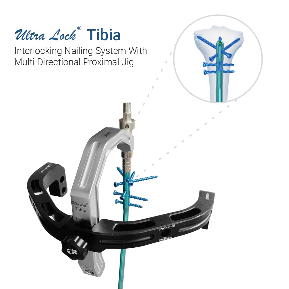 ultra lock tibia nail system by ortho max