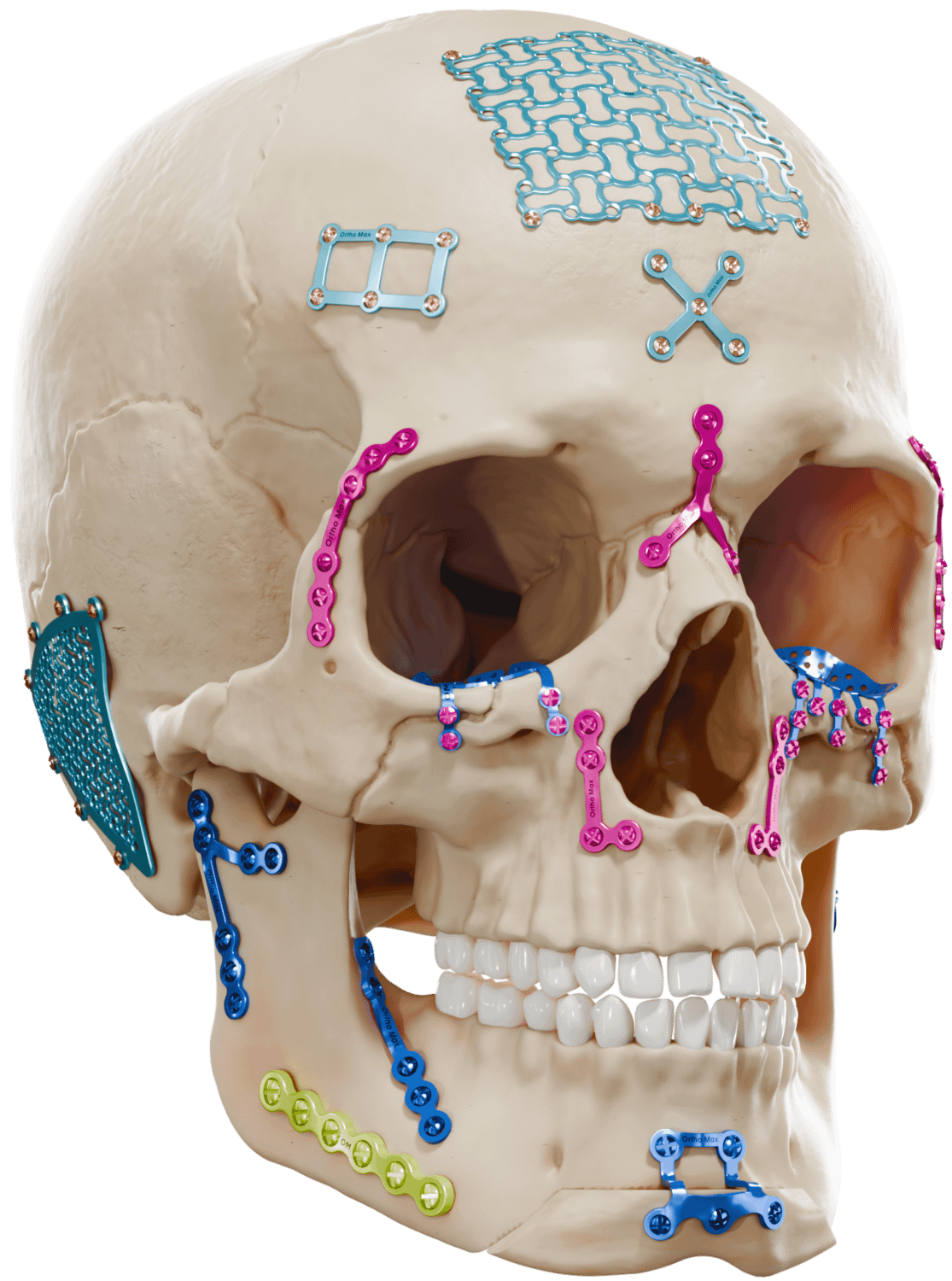 CMF SKULL with ALL PLATE & SCREWS right side