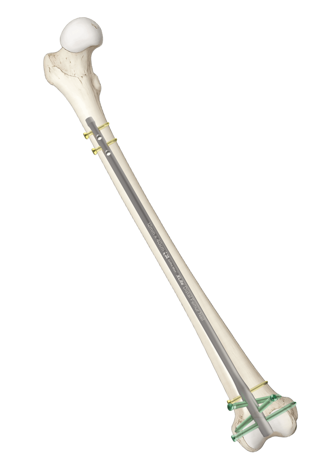 Xlite_Multiangle Retrograde Femur Nail Xlite_Multiangle Retrograde Femur Nail