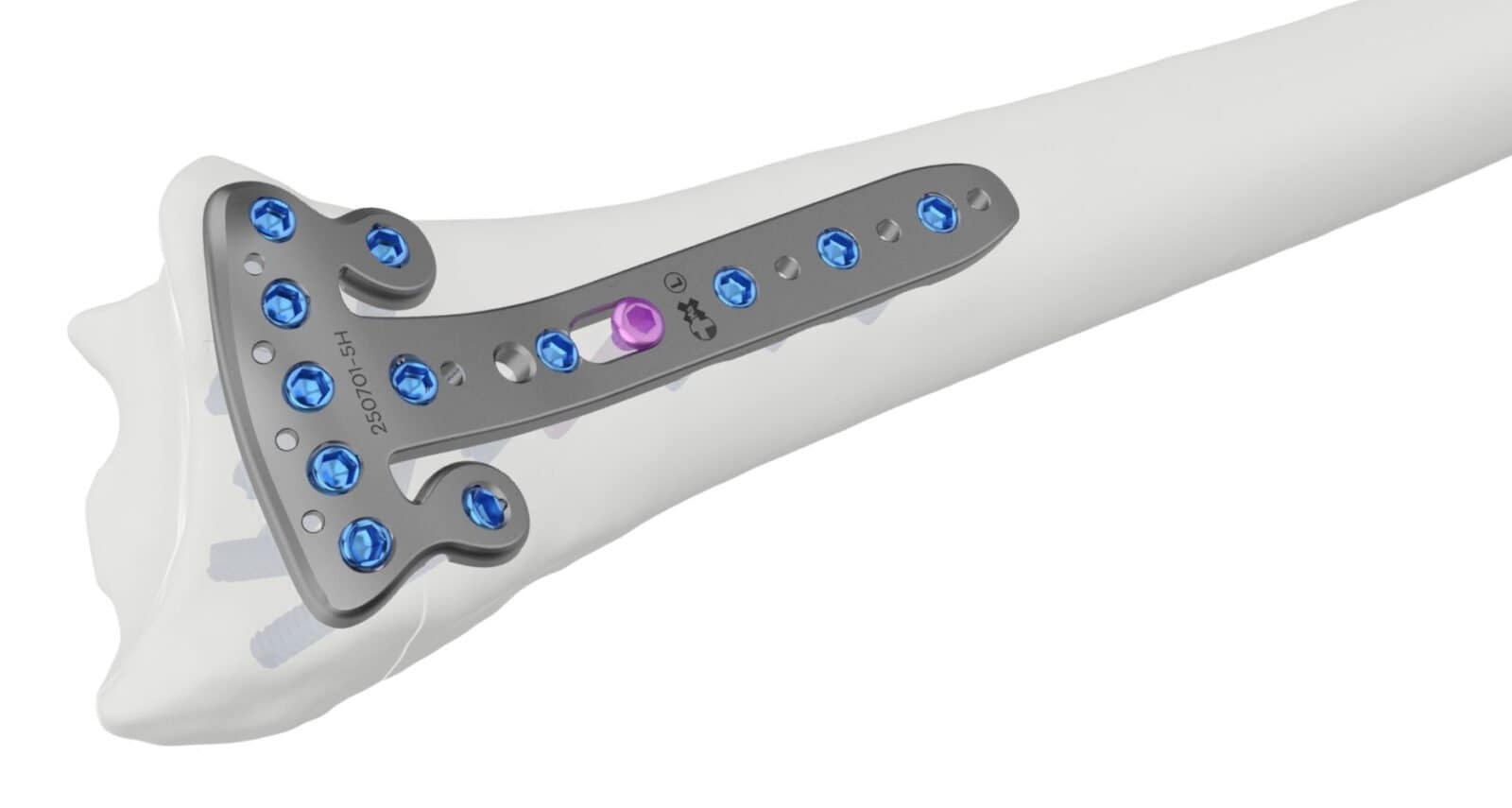 Ortho Max distal radius multi angle locking plate fitted on a bone model