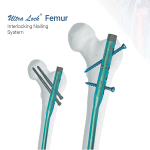 Ortho Max interlocking nailing system for femur, tibia and humerus