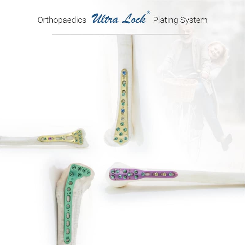 ultra lock plating system by ortho max